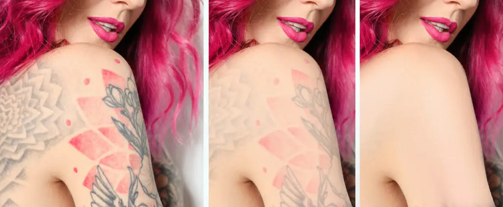Woman,Before,And,After,Laser,Tattoo,Removal,Procedures,,Closeup.,Collage