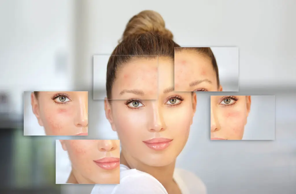 Post acne,Marks,/treating,Acne,Scars.acne,Scar,Removal