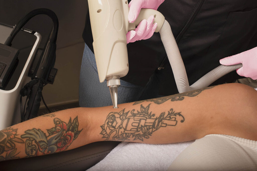 Tattoo op arm verwijderen