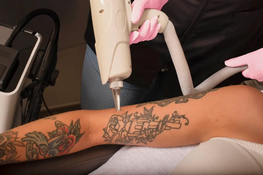 Tattoo op arm verwijderen