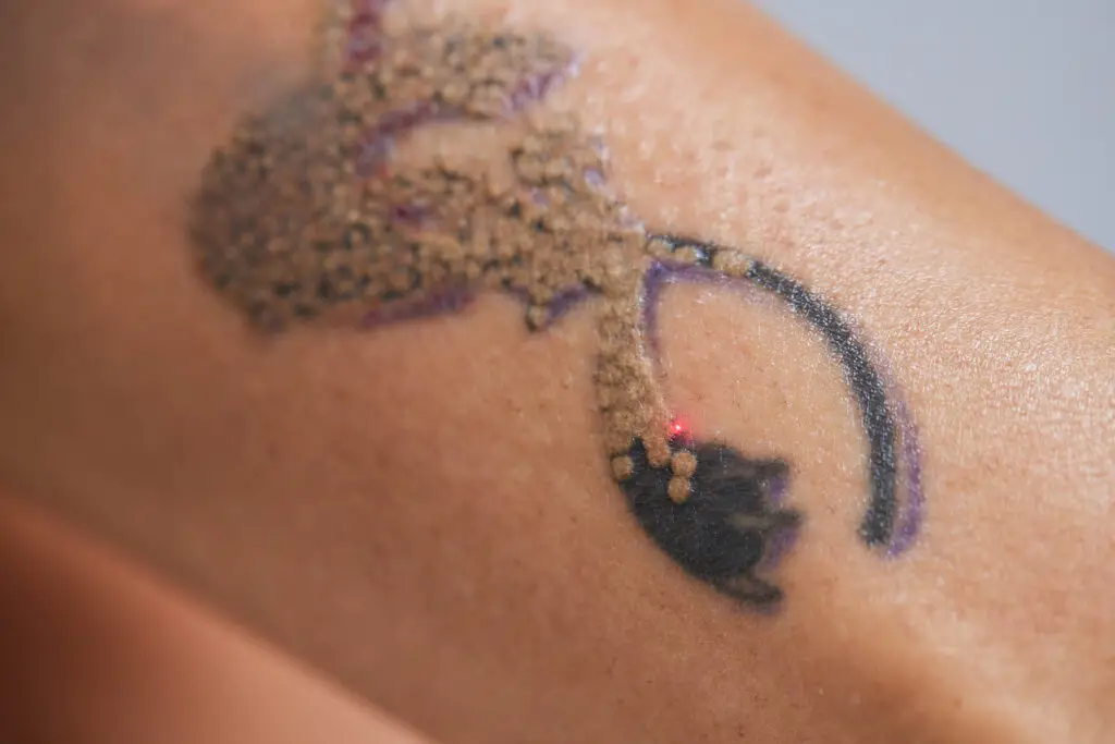 Young,Woman,Undergoing,Laser,Tattoo,Removal,Procedure,In,Salon,,Closeup.